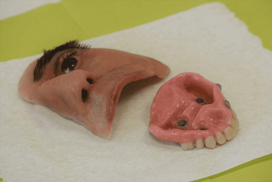 Prótesis facial — caso clínico